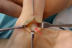 The patient in the scenario has a trigger thumb. Surgical correction of this condition requires the release of the A1 pulley. The A1 pulley is seen at the red arrow in Illustration A. During the dissection, the radial digital nerve crosses the ope...