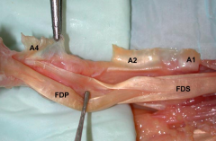 Unlike adults, release of the A-1 pulley in a pediatric trigger finger alone may not resolve triggering symptoms. Trigger finger in the child may be associated with a more proximal decussation of the FDS tendon, nodules in either the FDS or FDP te...