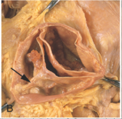 *Bicuspid Aortic Valve with Calcification
*Raphe is visible (paritally formed third cusp).