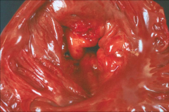 *MITRAL VALVE PROLAPSE VIEWED FROM LEFT ATRIUM.
*Lumen of valve is visible; valve is pouching into LA.