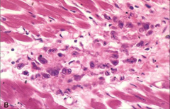 *ASCHOFF BODY in RHD; CLASSIC for RHD.

*FIBRINOID necrosis with lymphocytes, plasma cells, macrophages, giant cells, variable numbers of neutrophils and Anitschkow cells.