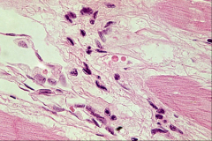 *ANITSCHKOW CELLS

*Anitschkow cells are often considered pathognomonic for RHD but these are from a 25 year old woman without RHD.