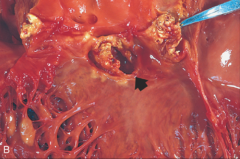 *Acute Endocarditis of Congenital Bicuspid Aortic Valve   (S. aureus...he says bicuspid AV is "probably" more likely to get infected).
*Cusps are pretty much destroyed. Arrow indicates beginning of a ring abscess forming.