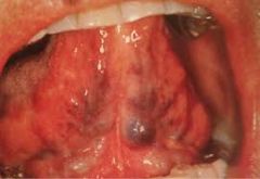 Enlarged blood vessels on the ventral surfaces of the tongue