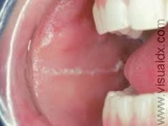 a white line on the buccal mucosa as a result of clenching