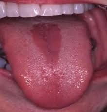 located on the midline of the dorsal of the tongue and may be cause by candida