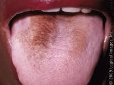 Elongated Filiform papillae and may be associated with smoking