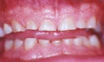 may be caused by mastication