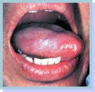 May be caused by a chronic denture irritation