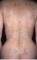 dermatitis herpetiormis- not sure, but it is autoimmune so maybe there is difuse attack o the body in dif locations (like Hashimoto's)

Maybe those MHC II's are more prone to both celiac's and DH
