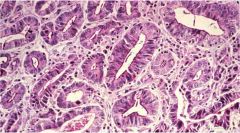 how differentiated is this adenocarcinoma