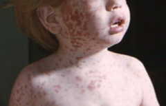 Togavirus
- Causes rubella, aka German (3-day) Measles
- Fever, postauricular and other lymphadenopathy, arthralgias and fine rash
- Mild disease in children, but severe congenitally