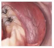 May be caused by chewing tobacco