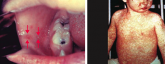 - Koplik spots - bright red spots with blue-white center on buccal mucosa that precedes measles rash by 1-2 days (left)
- Descending maculopapular, erythematous rash that includes limbs (right)

3 "C's" of measles:
- Cough
- Coryza (inflammat...
