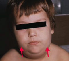 Mumps makes your parotid glands and testes as big as POM-poms
- Parotitis (picture)
- Orchitis (inflammation of testes)
- Aseptic Meningitis

- Can cause sterility (especially after puberty)