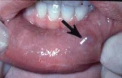 may be caused by severing a salivary duct