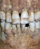 What is this dental disease?