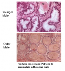 pseudostratified columnar/cuboidal epithelium
secretes various substances


can form concretions, accumulate with aging


peripheral zone-- most glandular tissue, common cancer site
transition zone-- location of urethra
central zone-- location of ...
