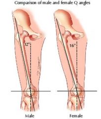 The angle that forms between the knee cap and greater trochanter (medially)
