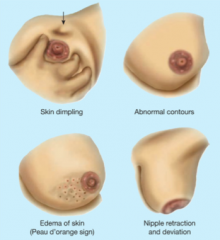 Lump, skin dimpling, peau d'orange, and nipple retraction