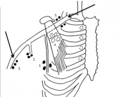 Pectoral (anterior) nodes
Subscapular (posterior) nodes
Brachial (lateral) nodes
Central nodes
Apical nodes
