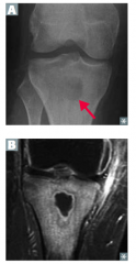 - Radiograph: more subtle (arrow in top picture)
- MRI: more easily seen
