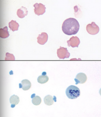Dx the condition:
What stain is used to confirm the presence of these structures?
