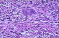 what is a leiomyosarcoma