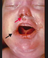 Which infection presents with stillbirth or hydrops fetalis in neonates; if the child survives presents with facial abnormalities (notched teeth, saddle nose, short maxilla), saber shins, and CN VIII deafness? Presentation in mother? Mode of trans...