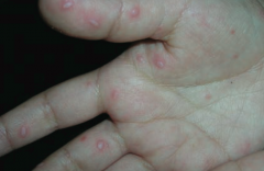 Hand-foot-mouth disease
- Vesicular rash on palms and soles
- Vesicles and ulcers in oral mucosa