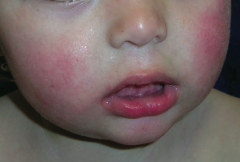 Erythema Infectiosum (Fifth Disease)
- "Slapped cheek" rash on face
- Can cause hydrops fetalis in pregnant women
