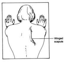 The long thoracic nerve
When injured this presents as a winged scapula