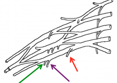 The branches of the medial cord of the brachial plexus
Green-Medial cutaneous nerves of the forearm
Purple-Medial cutaneous nerves of the arm
Red-Medial pectoral nerve