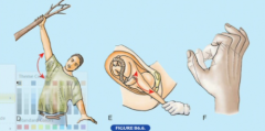 When the upper limb is hyperabducted such to break a fall or when a baby is pulled excessively during delivery