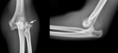 An elbow dislocation