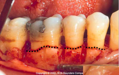 abnormal gingival and/or osseous marginal contours; commonly not parabolic in form with the inter proximal tissue located in an abnormally apical position 