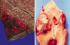 - Red (hemorrhagic) infarcts occur in loose tissues with multiple blood supplies (left)
- Liver, lungs, intestine
- Red = Reperfusion (injury is due to damage by free radicals)