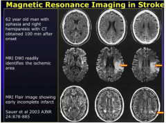 Notice the differences between CT and MRI (taken one - two hours after symptom onset).