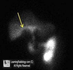 What is this imaging sign and where is it seen?