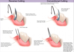 Conventional: Needle is square in cross section 


Reverse cutting: triangular cross section. 