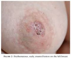 unilateral eczema nipple; reflect adenocarcinoma underlying