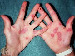 Target annular lesions with red or dusky cyanotic centre with bright red ring on outside; initially macular but becomes raised. 
Starts on hands & feet but can spread
Can effect mucosa  

 Most common <40; M>F
 Due to herpes or mycoplasma; rarely ...
