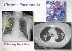 Symptoms are non-specific so epidemiological and exposure history is critical. Chest imaging (CXR and CT) are best. 