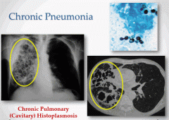 Elderly/debilitated patients (aspiration pneumonia), Af. Am. (TB), COPD patients (histo), HCW (TB), archeologisits (cocidioidomycosis), upper mid-West US (histo), SE Asia (meliodosis), HIV (TB), homeless/alcoholics (TB), immunocompromised. 