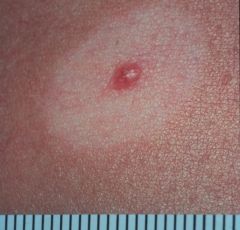 Melanocytic nevi under immune attack with destruction of melanocytes; appear in adults with MM elsewhere - check whole body