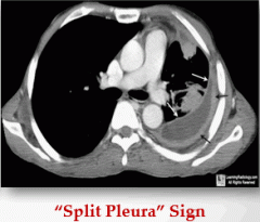 Physical exam: decreased breath sounds, dullness to percussion and crackles.


 


Imaging: CXR will show blunted costo-phrenic angle and free fluid in lateral decubitus. CT is best for emypema and will show "split pluera" sign. 
