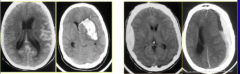 Identify the different types of cerebral hemorrhage: subarachnoid, epidural, subdural, and intracerebral