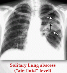 CXR and CT showing lung cavity with air-fluid levels. LRT sample for gram stain and culture to determine organism. Blood culture for secondary abscess. 


 


Management is usually just antibiotics targeting specific bacteria. Antibiotic sho...