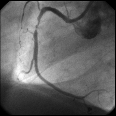 Angiogram in unstable angina:eccentric, ulcerated plaque