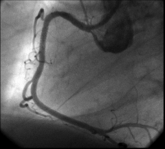 Angiogram in unstable angina: after stent deployment